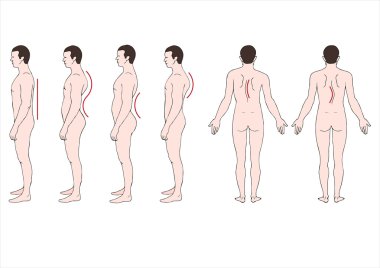 Deformstion of the spine 